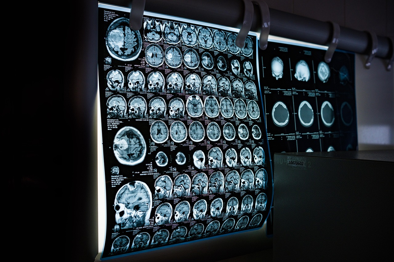 Traumatic Brain Injuries (TBI): The 'Invisible' Injury